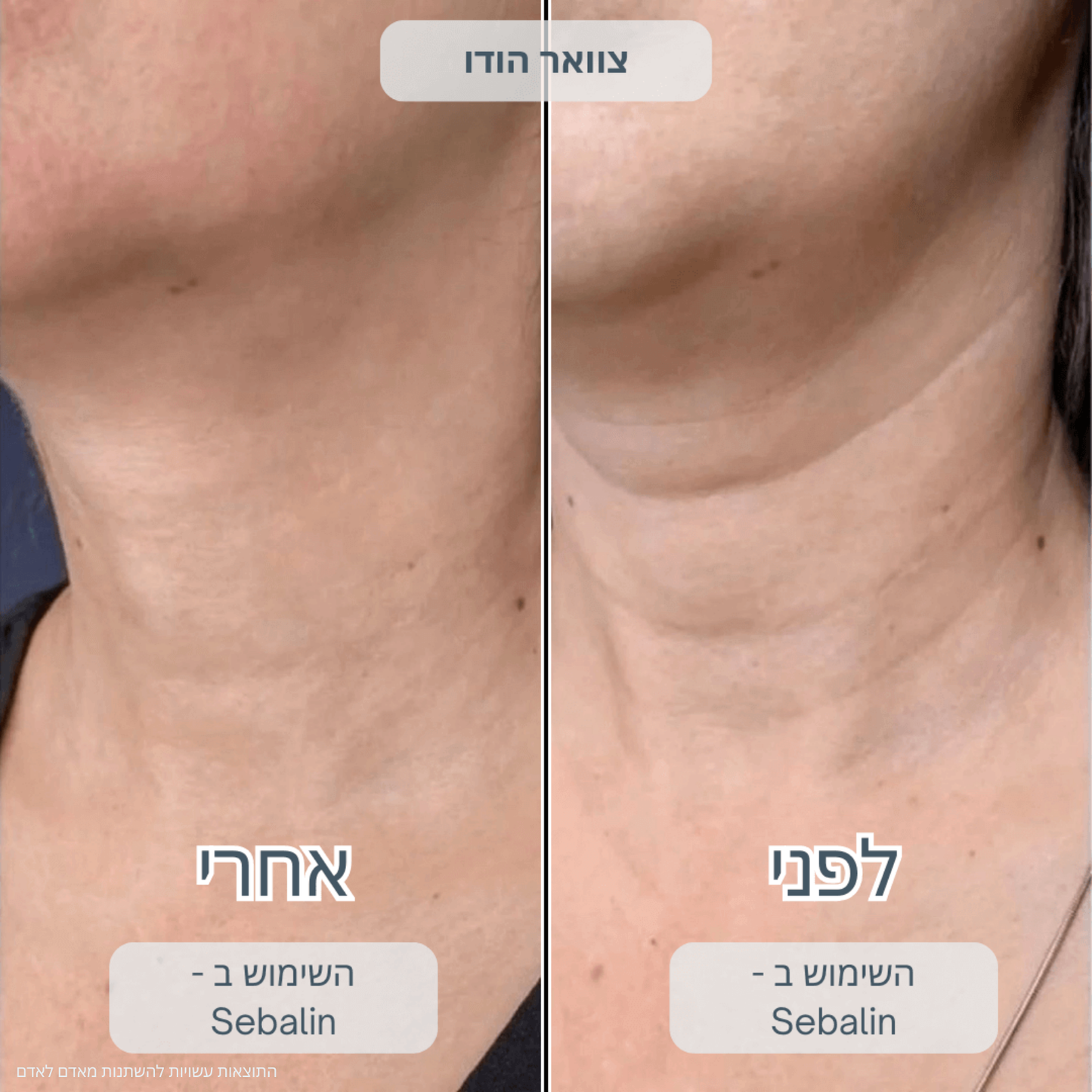 SEBALIN – טיפול פנים מתקדם לעור הפנים