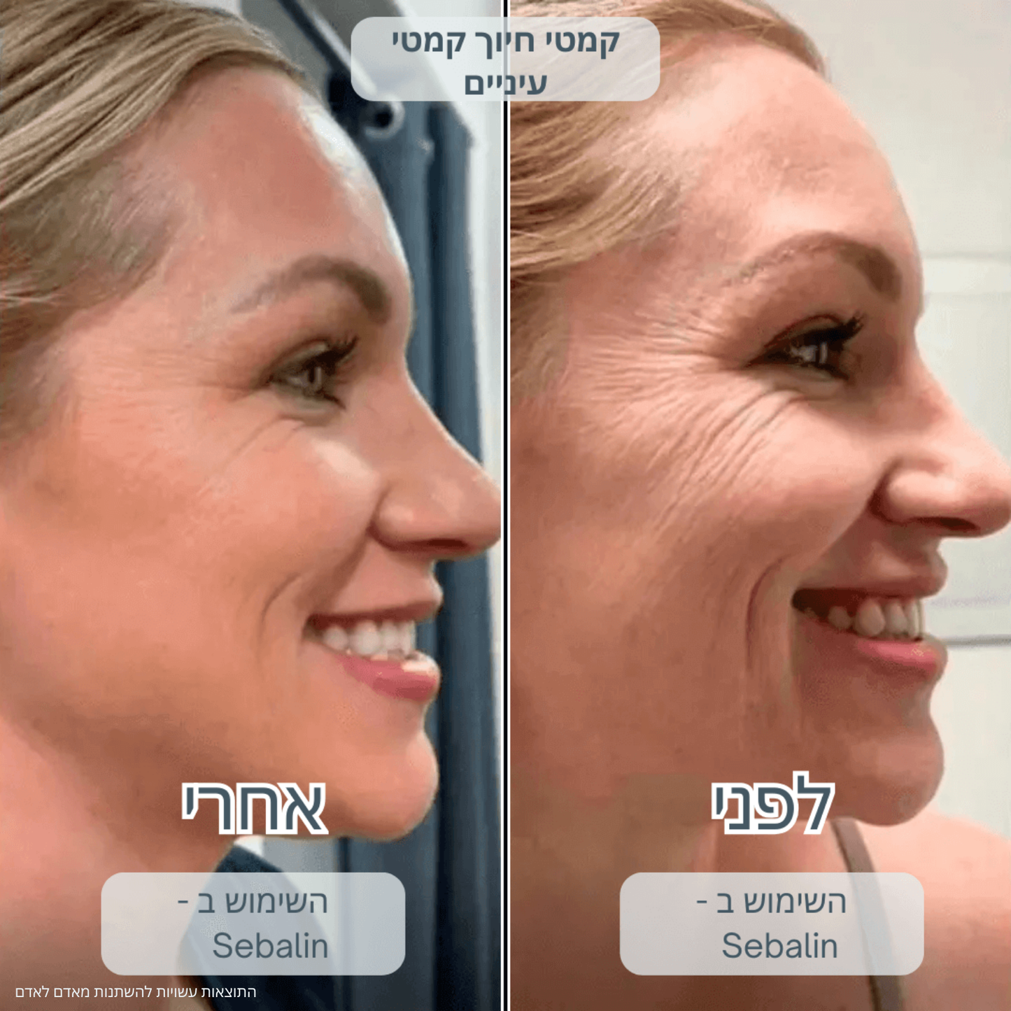 SEBALIN – טיפול פנים מתקדם לעור הפנים