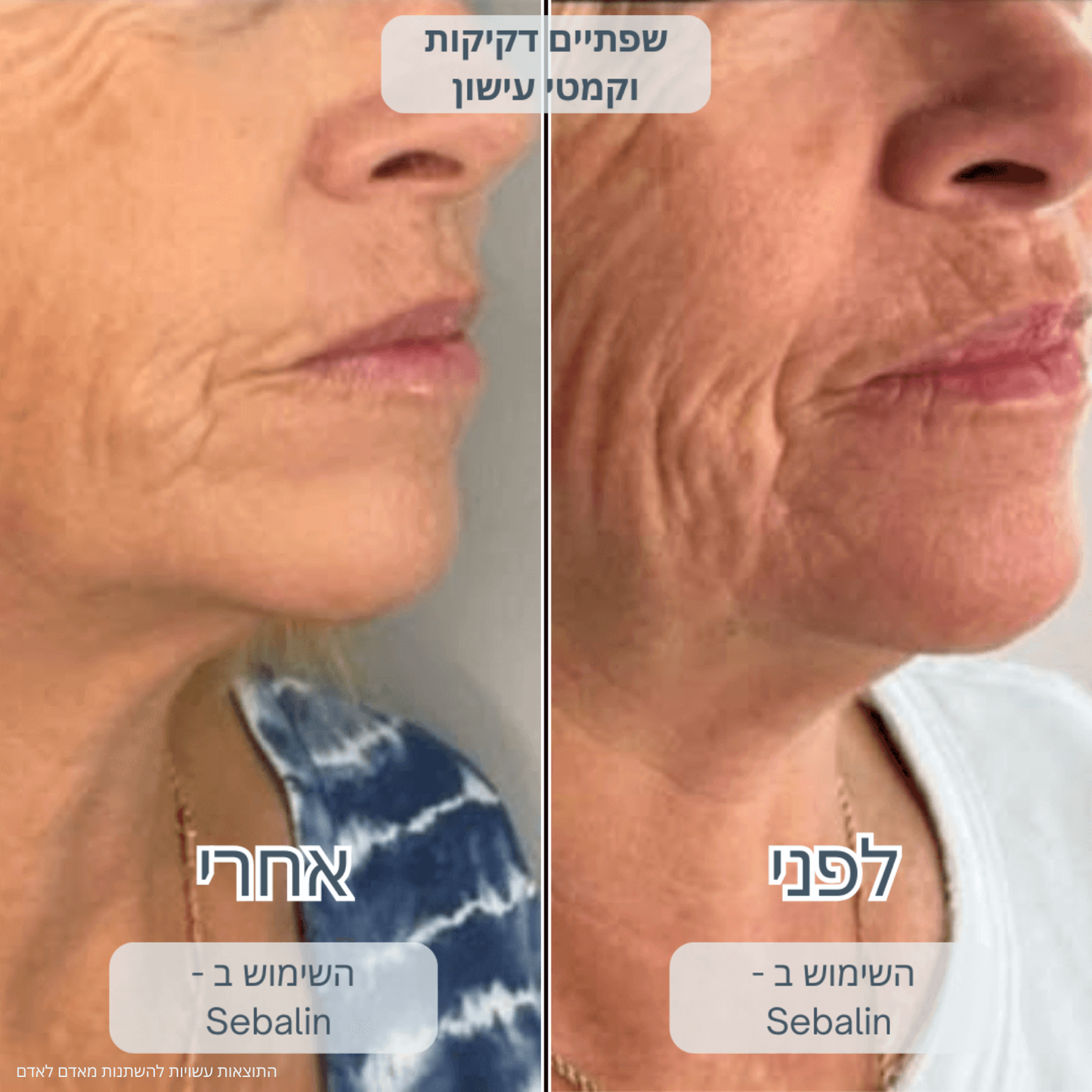 SEBALIN – טיפול פנים מתקדם לעור הפנים
